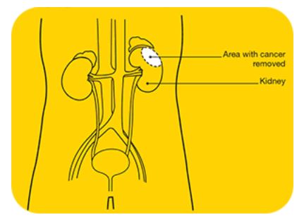 Kidney Cancer 2 Kidney Cancer 2