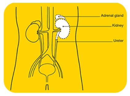 Kidney Cancer 3 Kidney Cancer 3