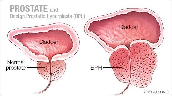 Prostate