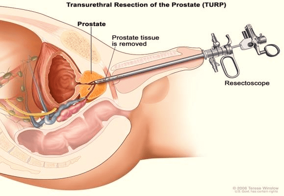 TURP