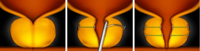 Prostate Enlargement